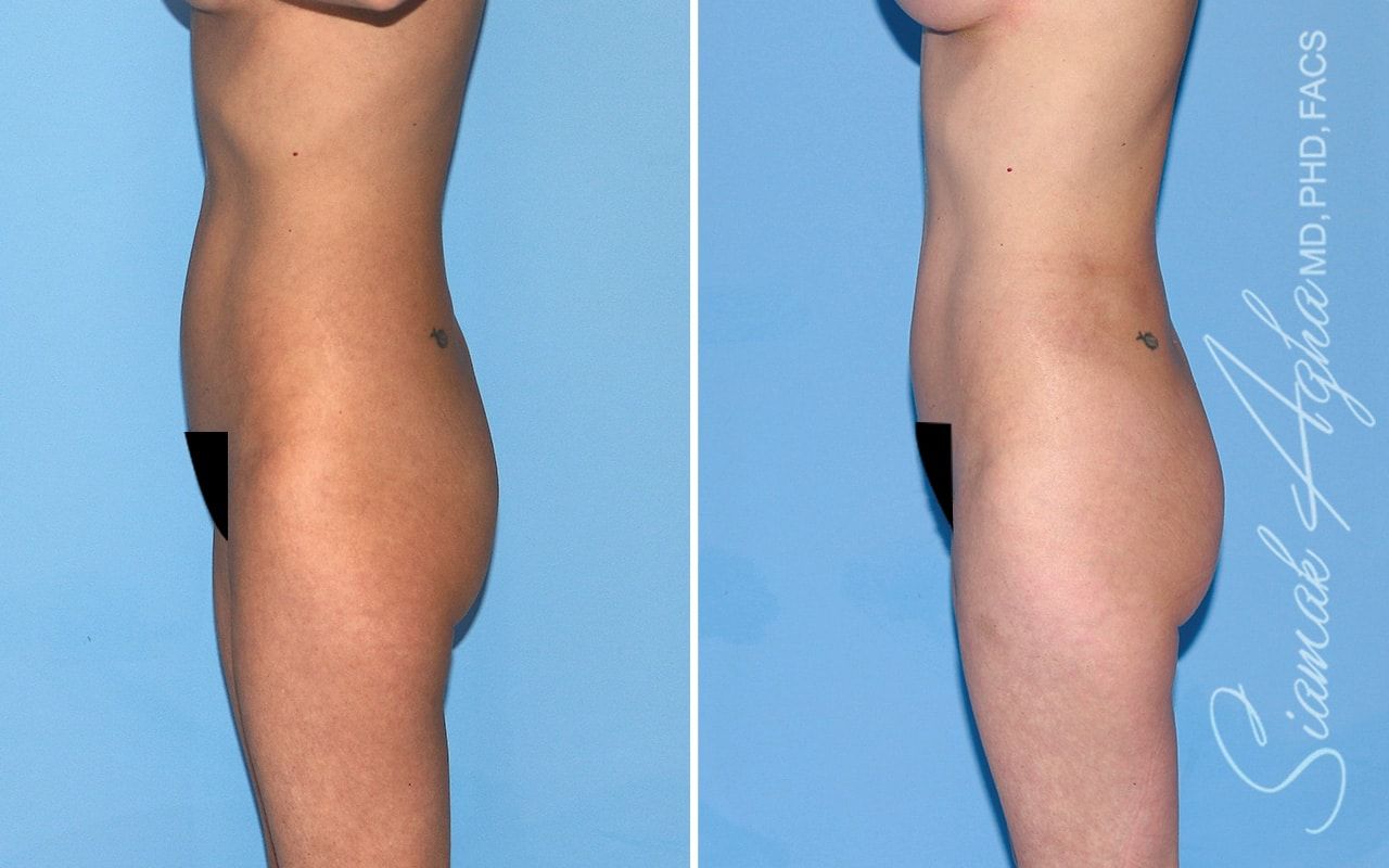 Brazilian Butt Lift Before & After