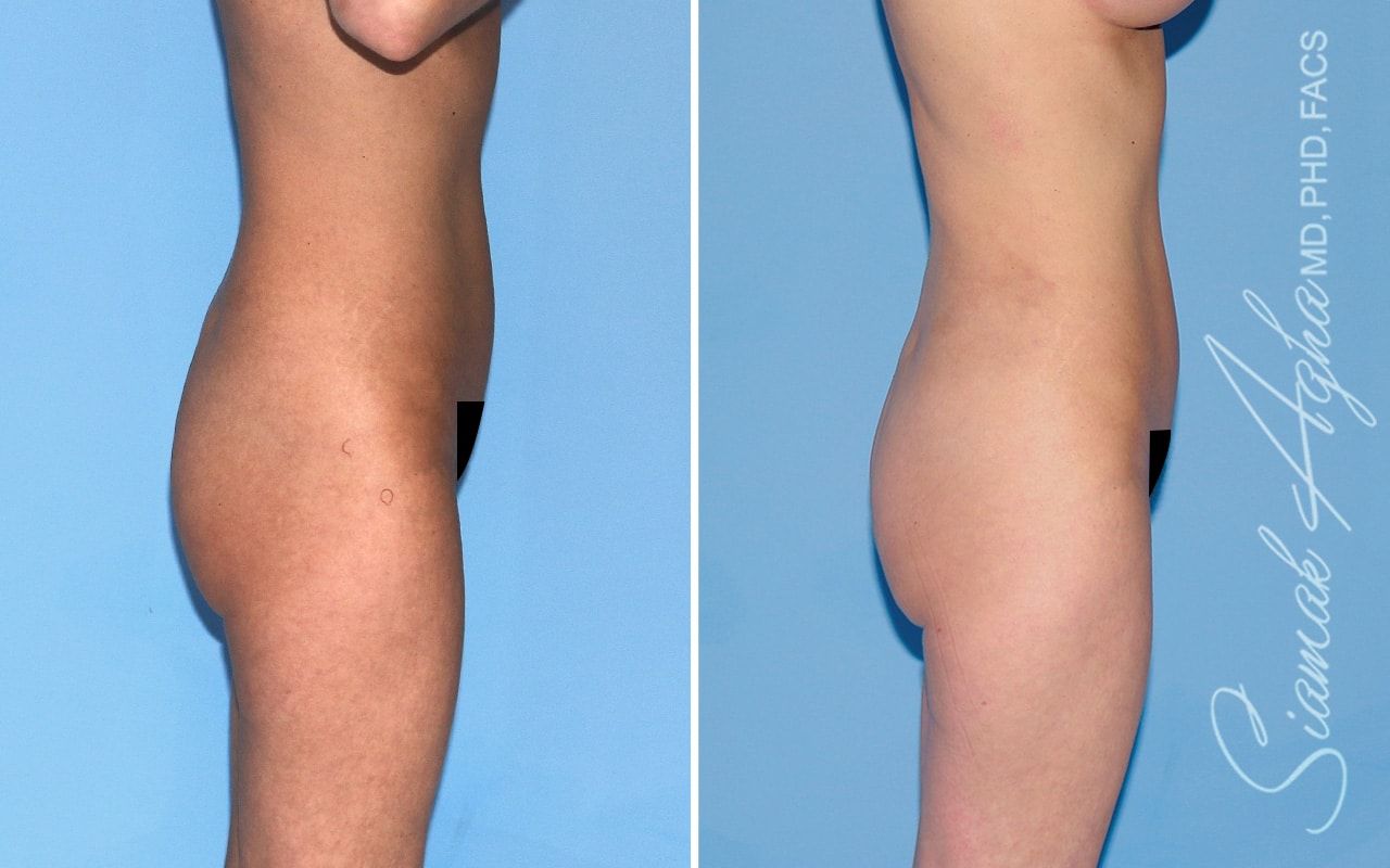 Brazilian Butt Lift Before & After