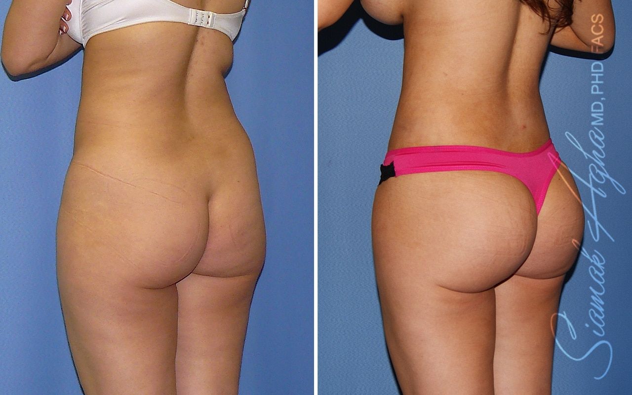 Brazilian Butt Lift Before & After