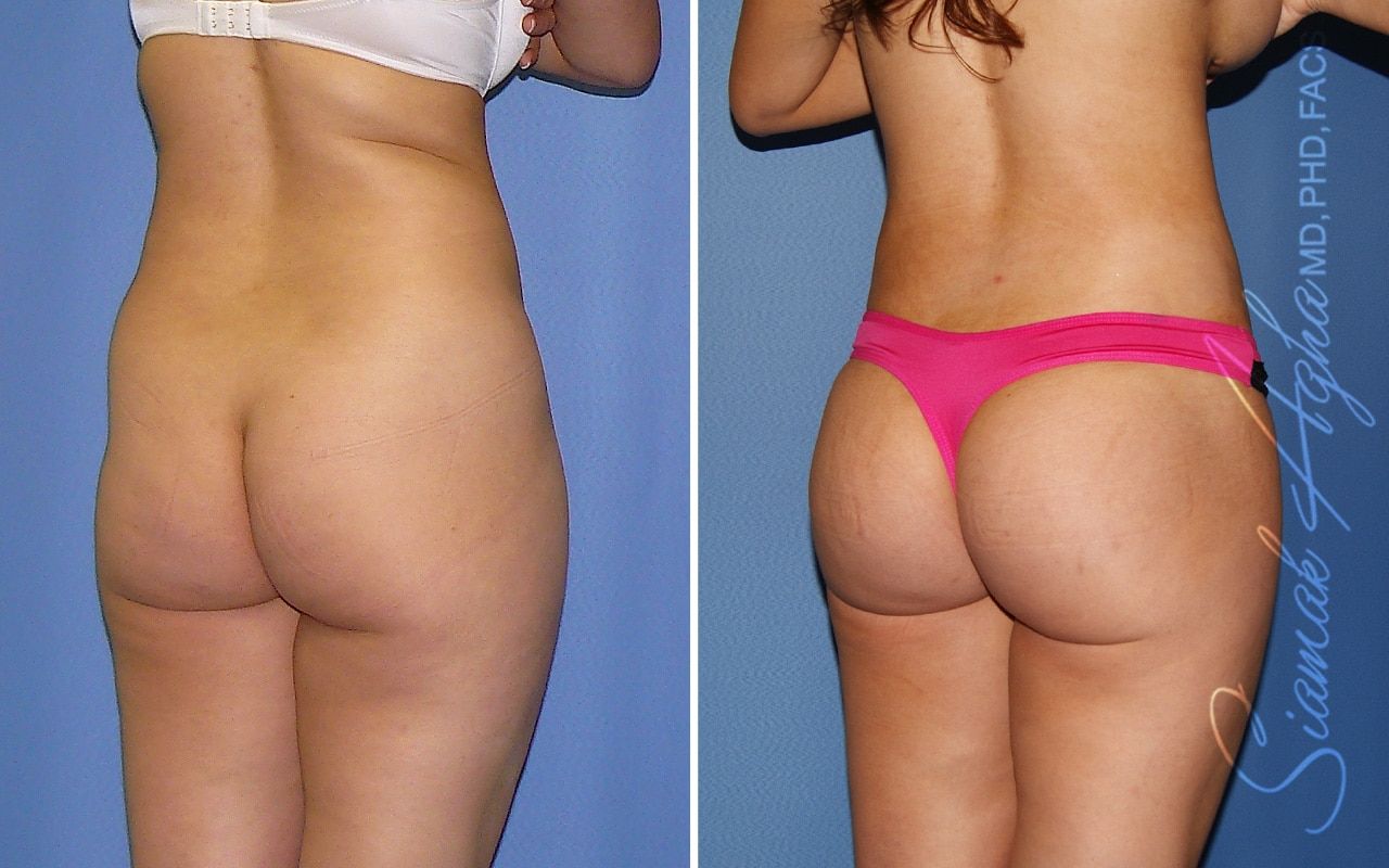 Brazilian Butt Lift Before & After