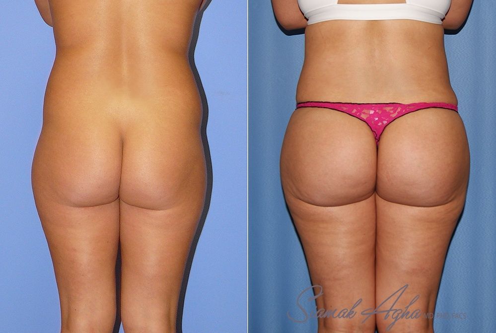 Brazilian Butt Lift Before & After