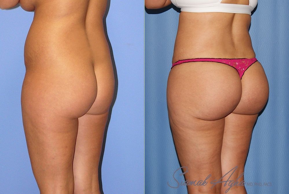 Brazilian Butt Lift Before & After
