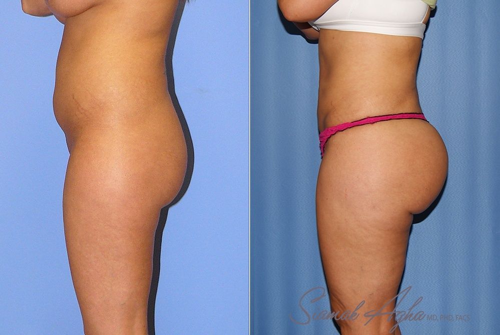 Brazilian Butt Lift Before & After