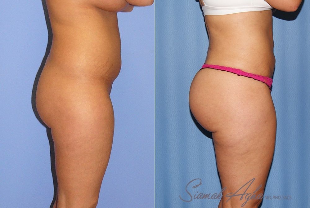 Brazilian Butt Lift Before & After