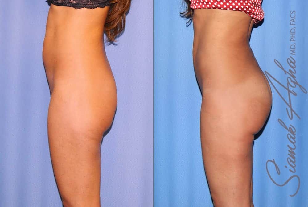 Brazilian Butt Lift Before & After