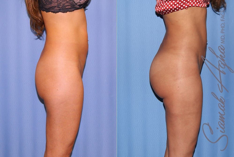 Brazilian Butt Lift Before & After