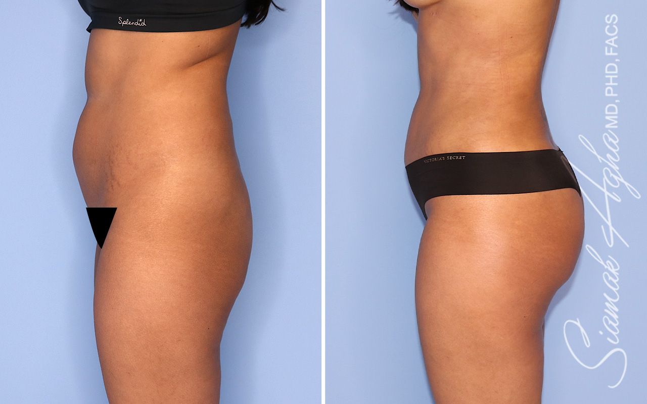 Brazilian Butt Lift Before & After