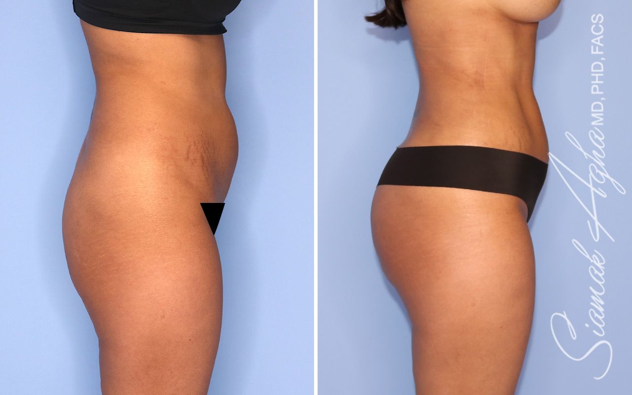 Brazilian Butt Lift Before & After