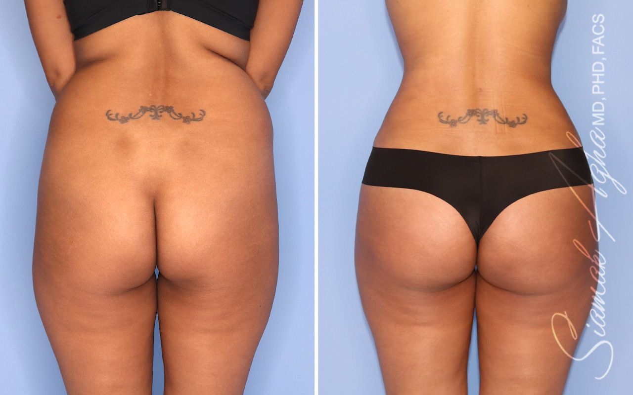 Brazilian Butt Lift Before & After
