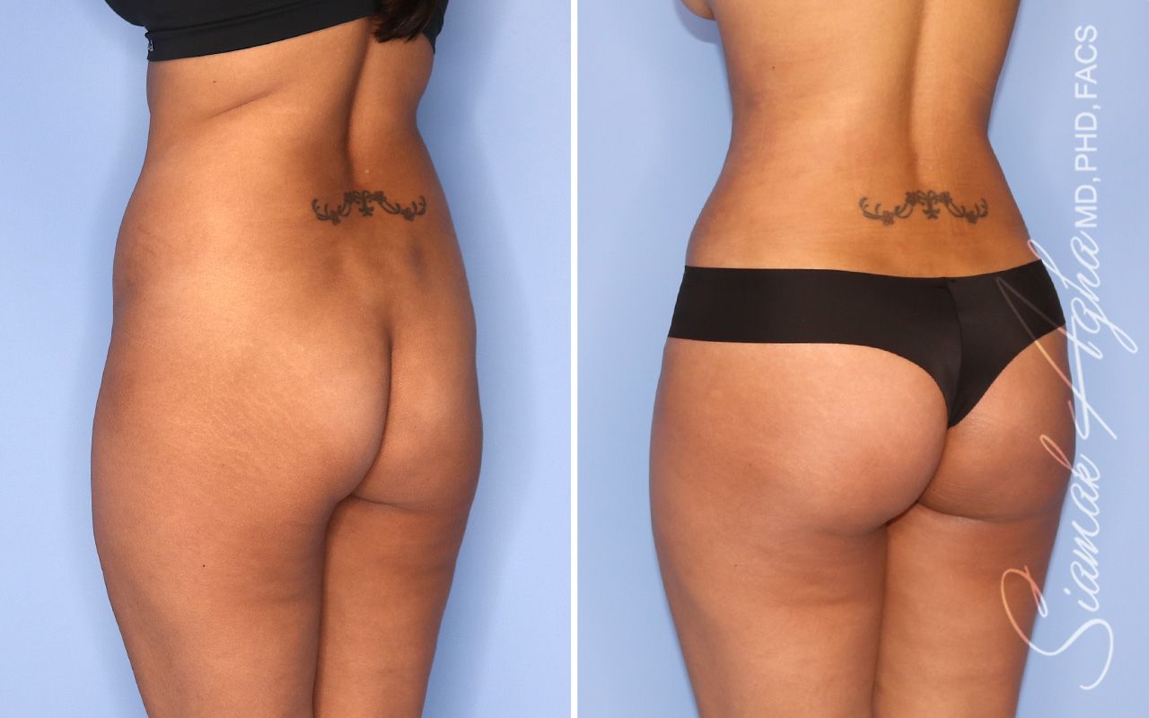 Brazilian Butt Lift Before & After