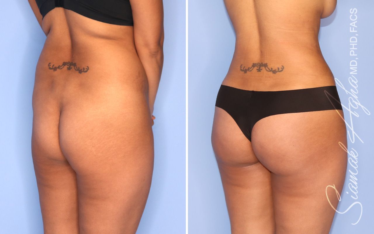 Brazilian Butt Lift Before & After