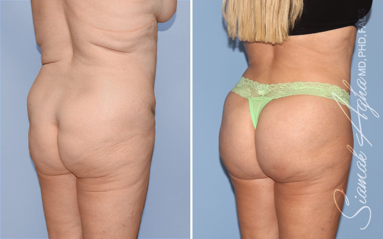Brazilian Butt Lift Before & After