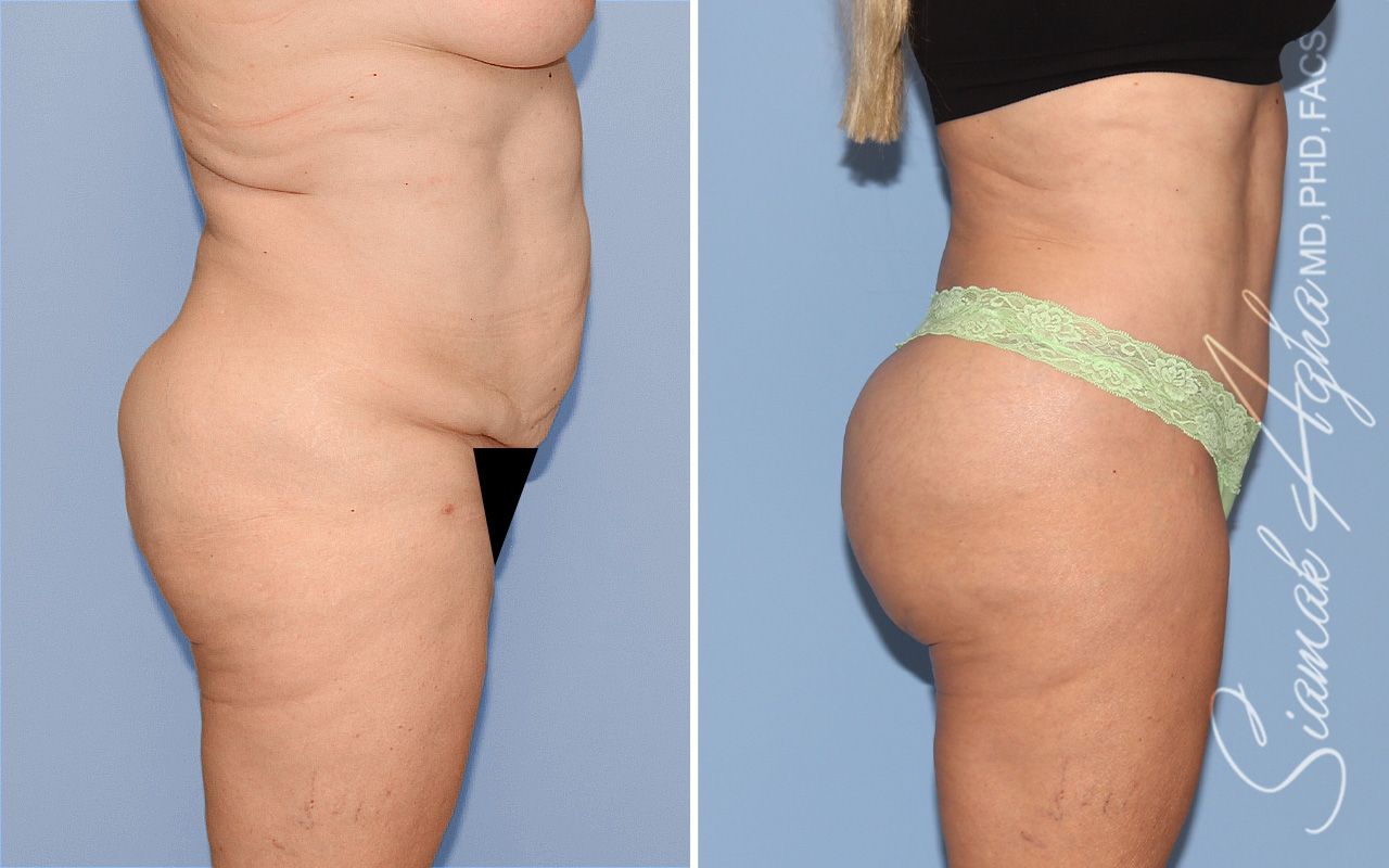 Brazilian Butt Lift Before & After
