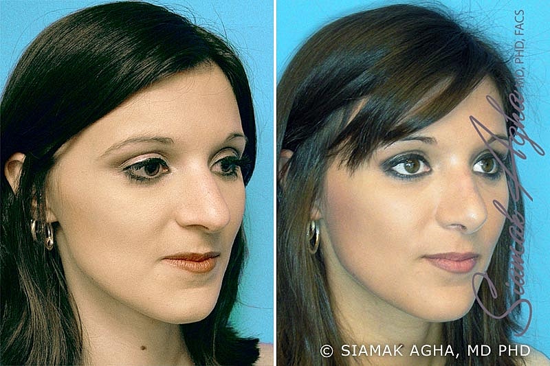 Rhinoplasty Before & After