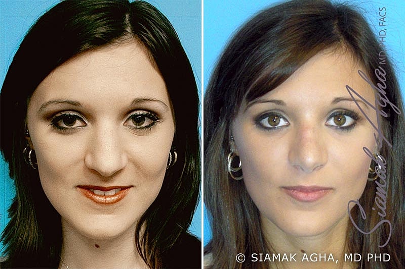 Rhinoplasty Before & After