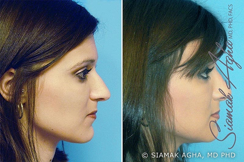 Rhinoplasty Before & After