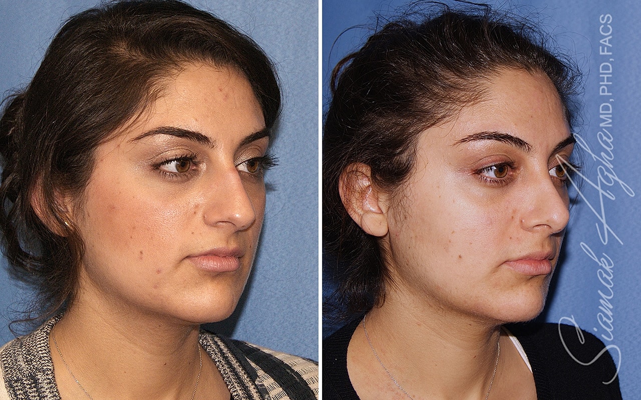 Rhinoplasty Before & After