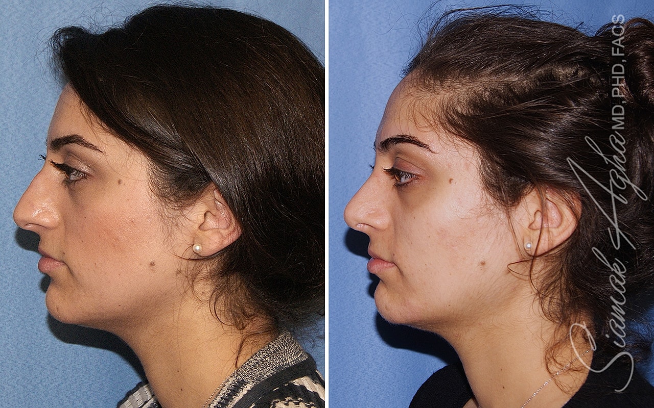 Rhinoplasty Before & After