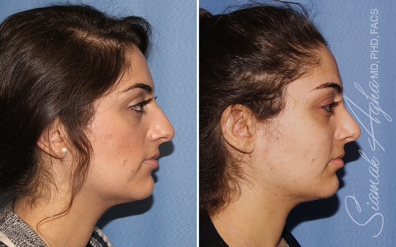 Rhinoplasty Before & After