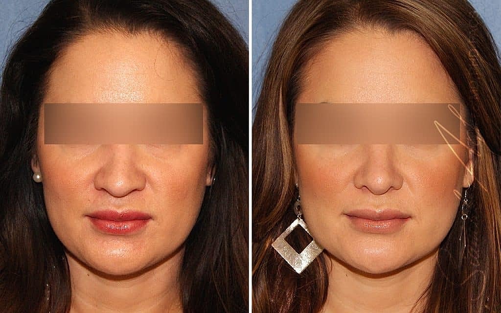 Rhinoplasty Before & After