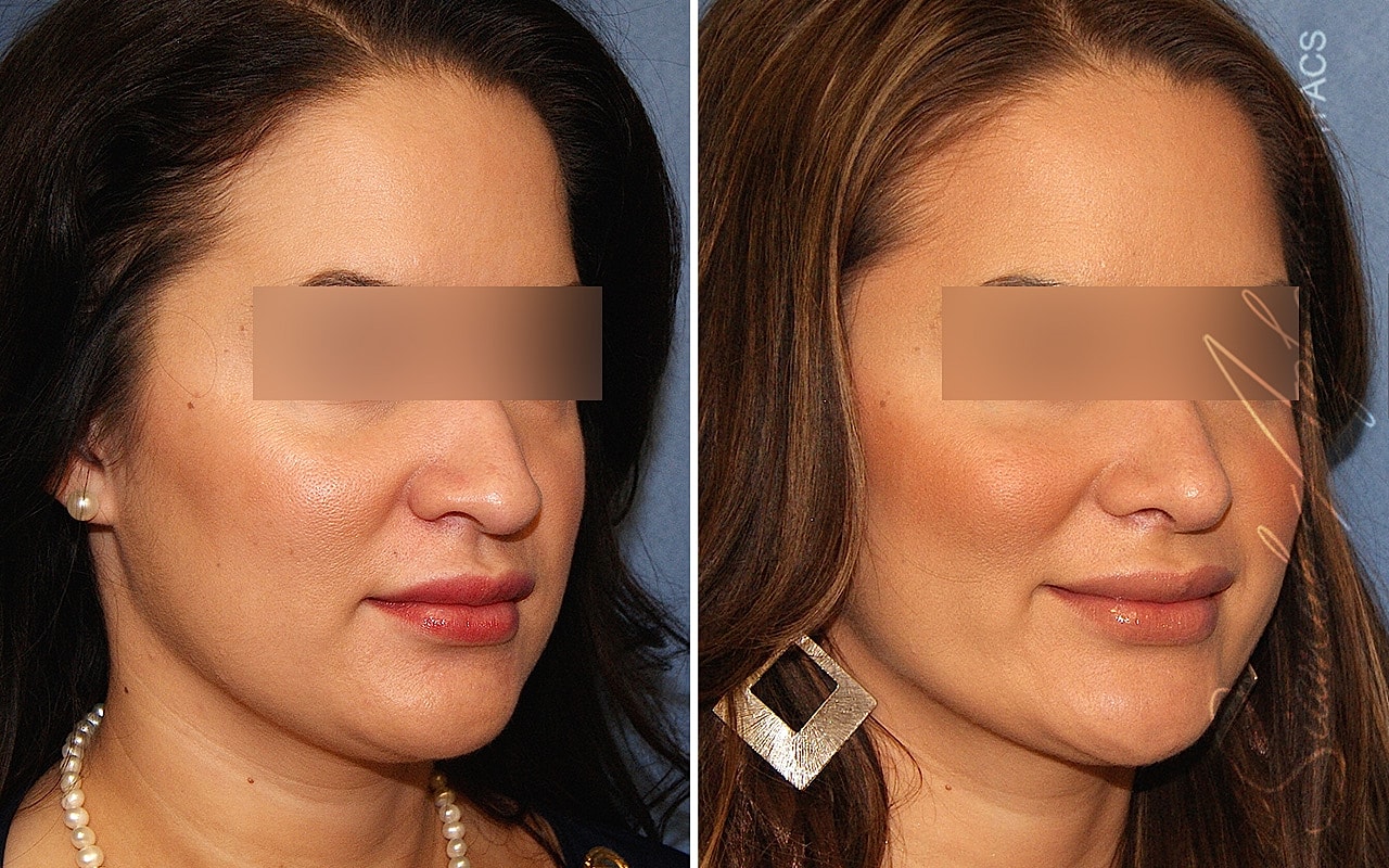 Rhinoplasty Before & After