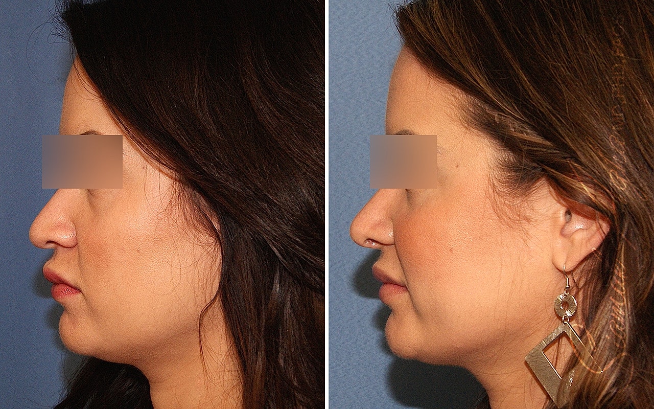 Rhinoplasty Before & After