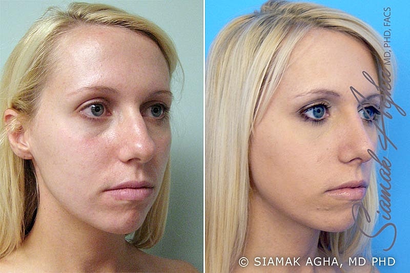 Rhinoplasty Before & After