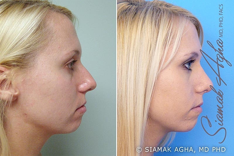 Rhinoplasty Before & After