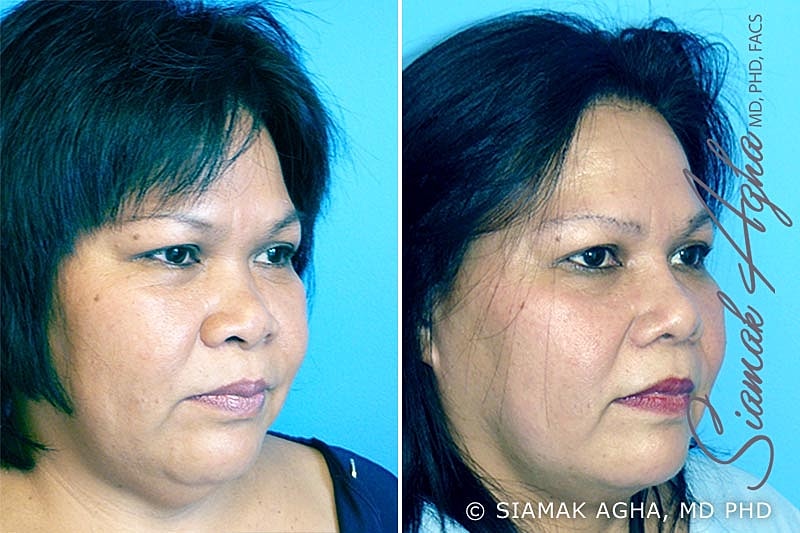 Rhinoplasty Before & After