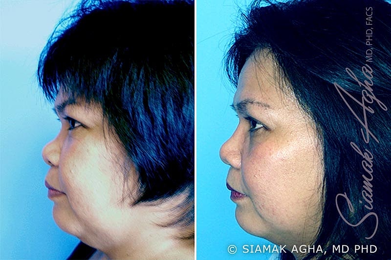 Rhinoplasty Before & After