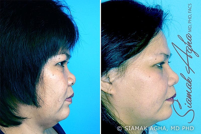 Rhinoplasty Before & After