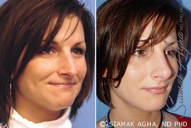 Rhinoplasty Before & After