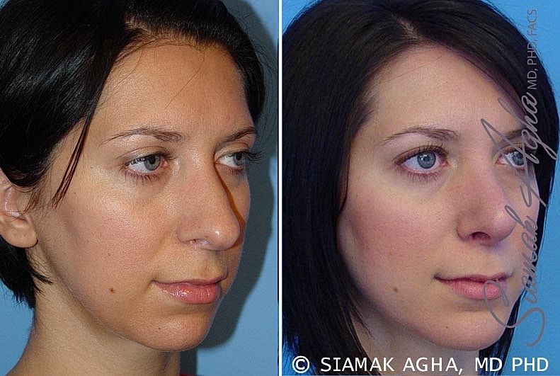 Rhinoplasty Before & After
