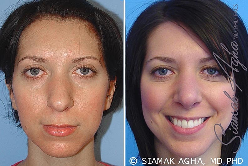 Rhinoplasty Before & After
