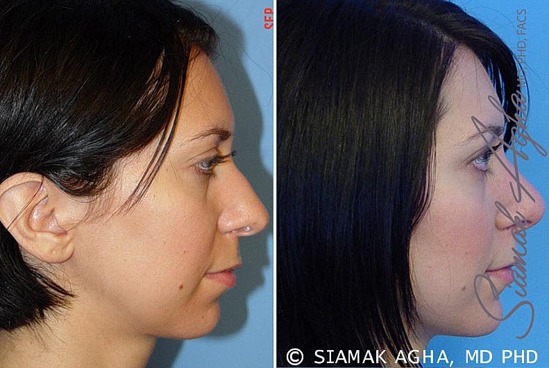 Rhinoplasty Before & After