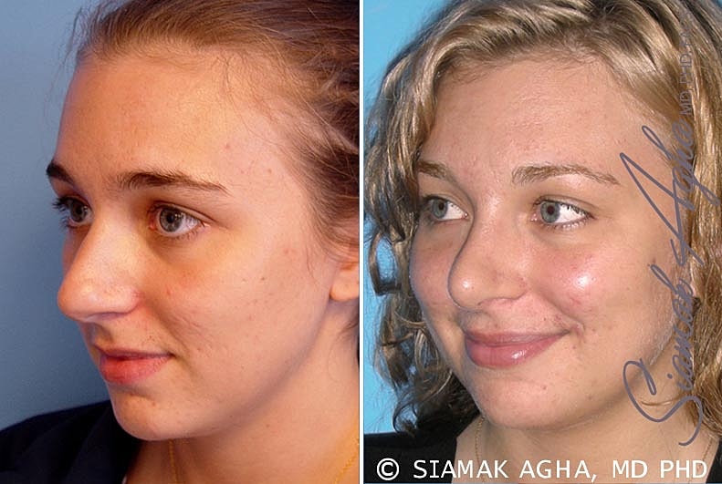 Rhinoplasty Before & After