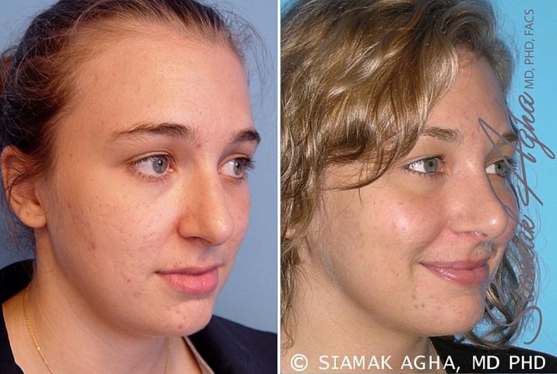 Rhinoplasty Before & After