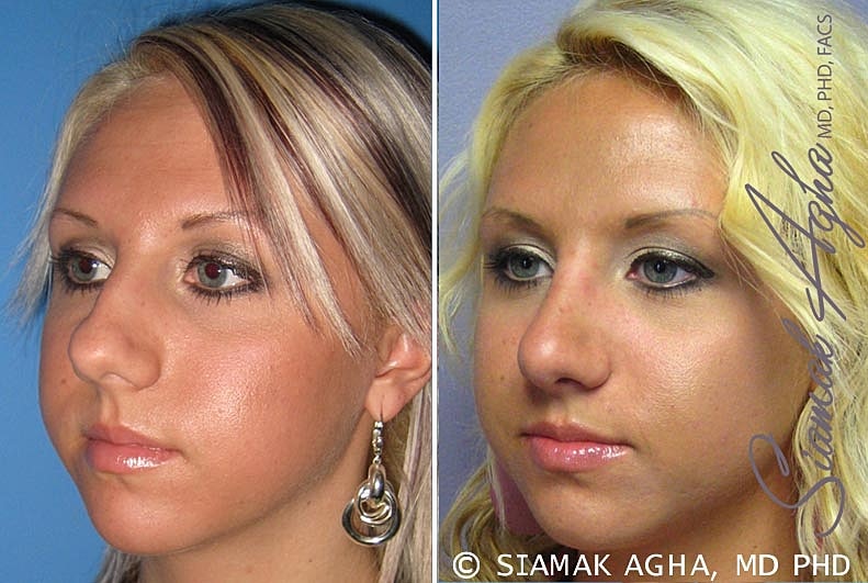 Rhinoplasty Before & After