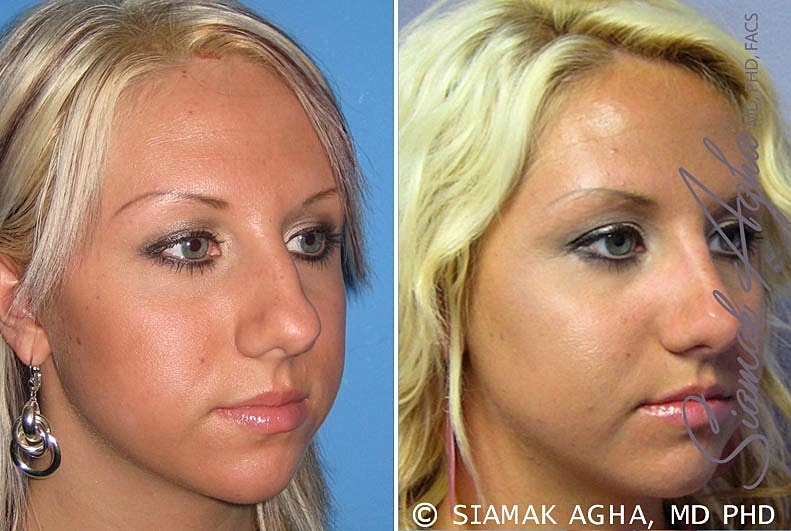 Rhinoplasty Before & After