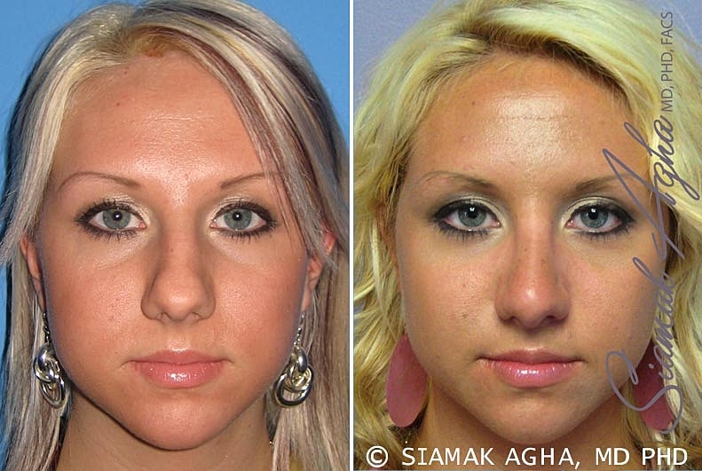 Rhinoplasty Before & After