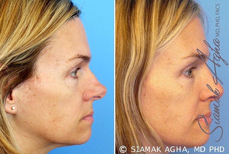 Rhinoplasty Before & After