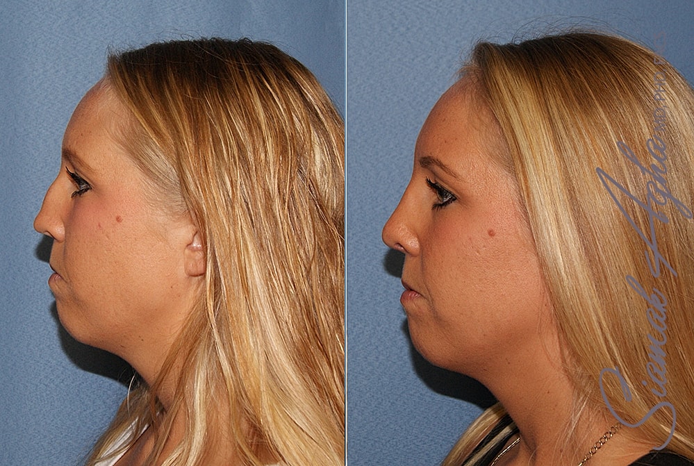 Rhinoplasty Before & After