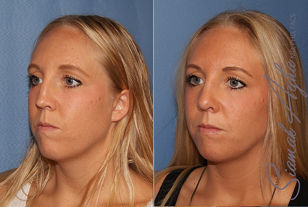 Rhinoplasty Before & After