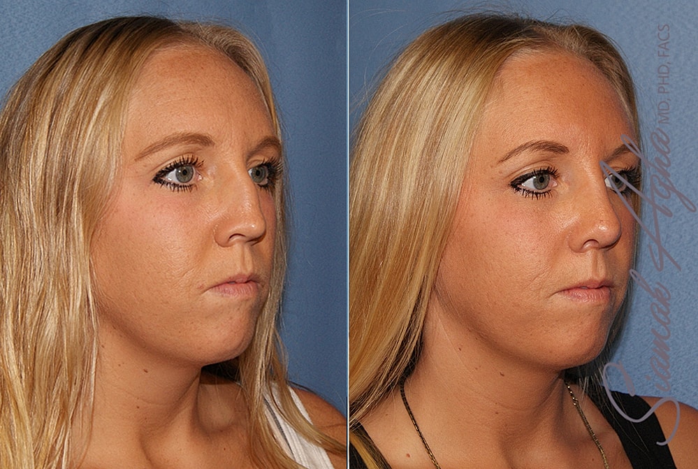 Rhinoplasty Before & After