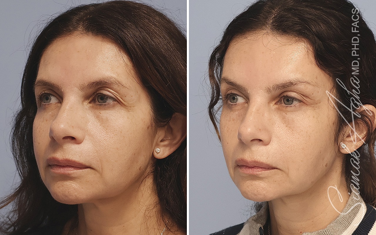 Brow Lift Before & After