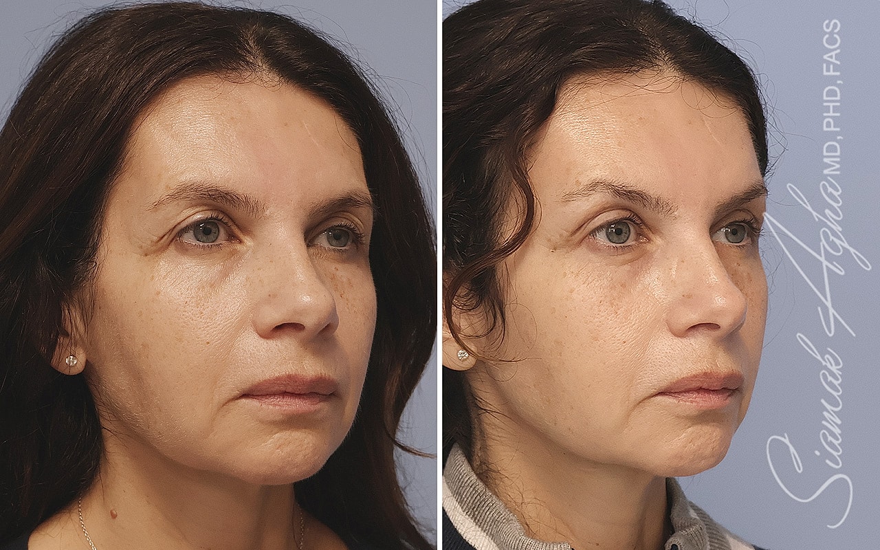 Brow Lift Before & After