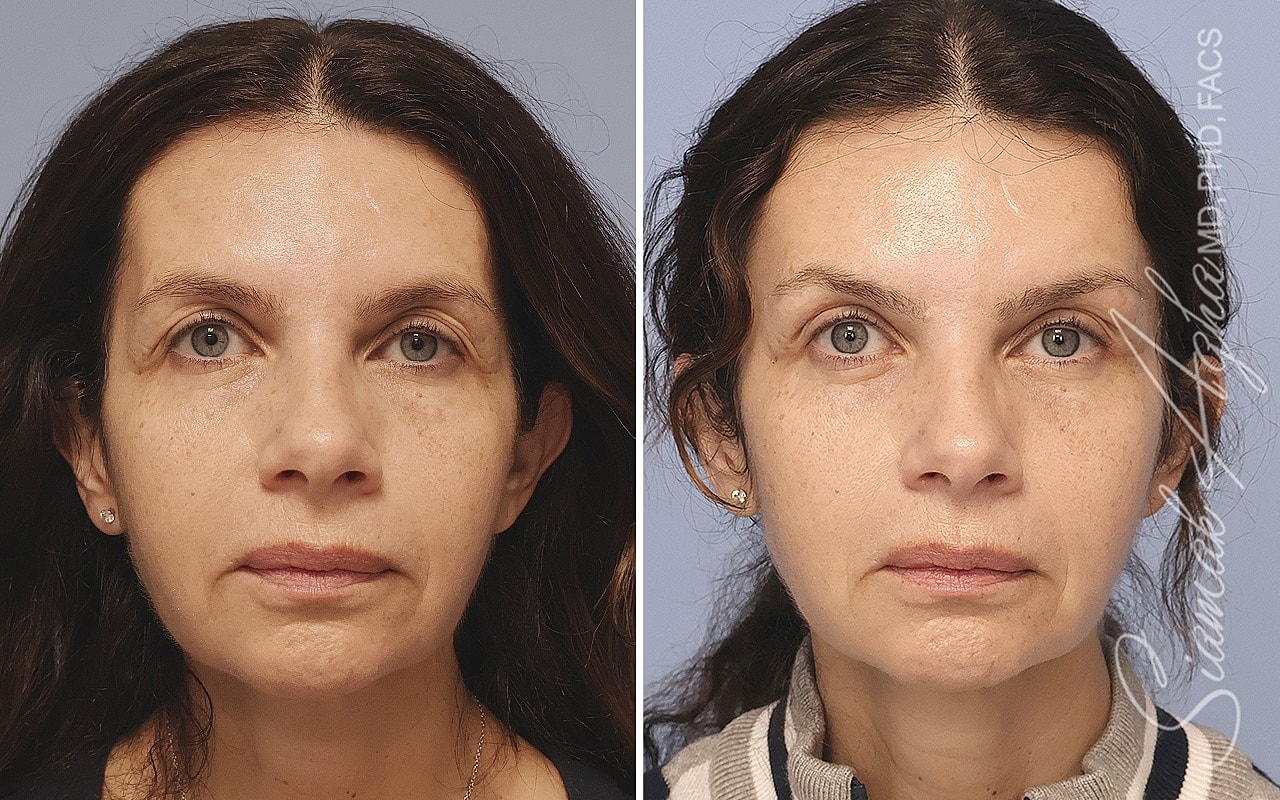 Brow Lift Before & After
