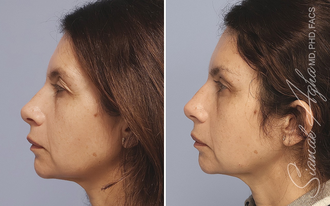Brow Lift Before & After