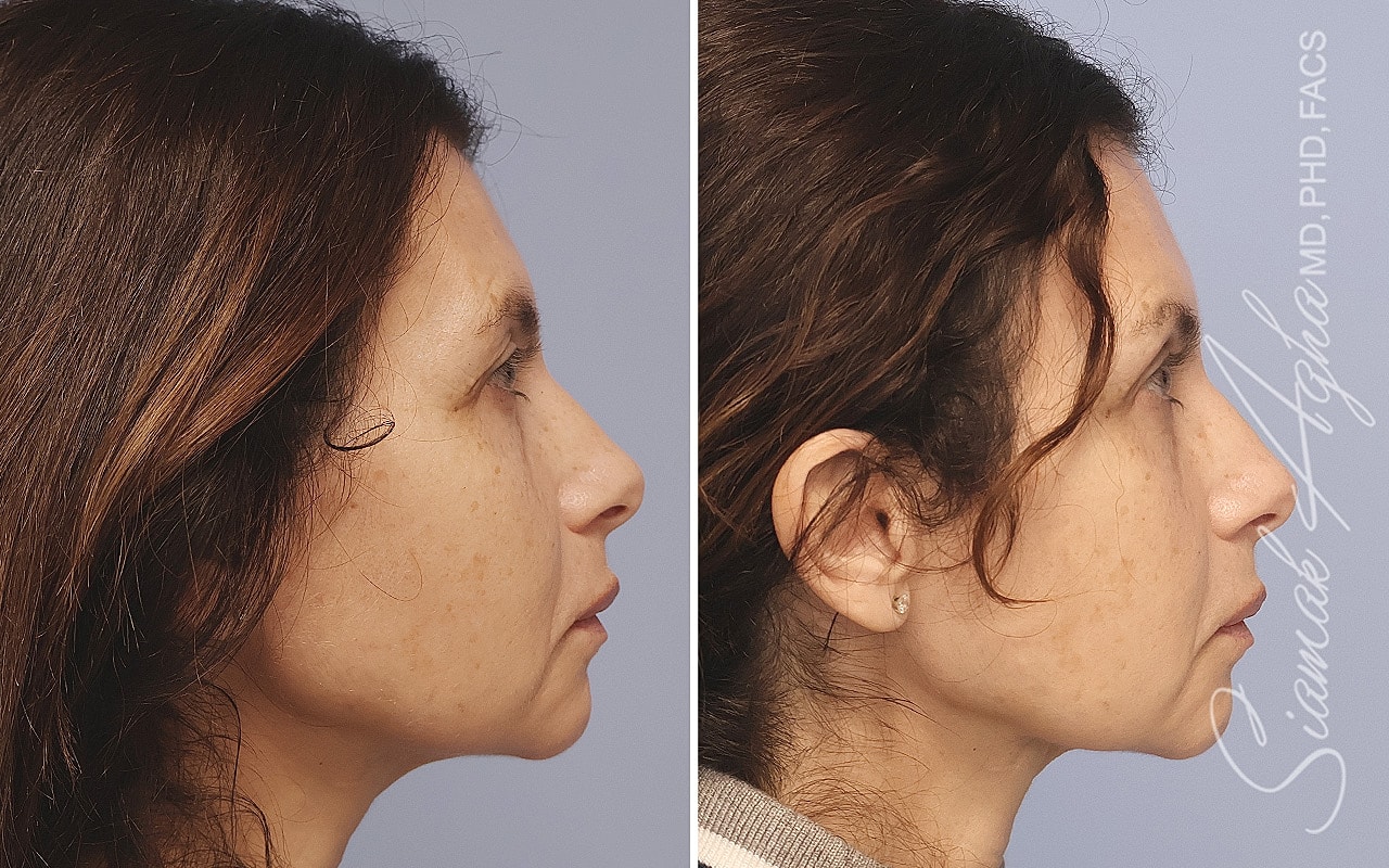 Brow Lift Before & After