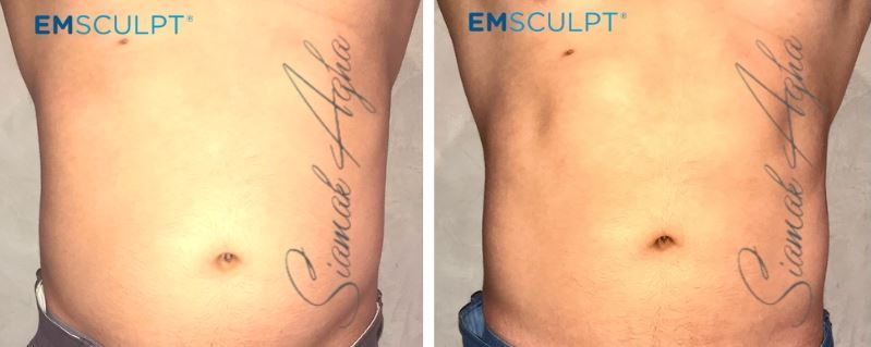 Emsculpt Before & After